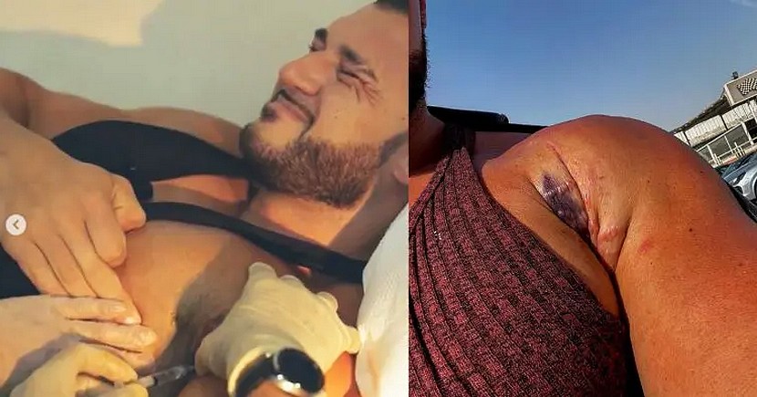 Райан Кроули снова разорвал грудную мышцу