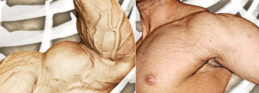 Растяжки: причины возникновения, профилактика и методы борьбы