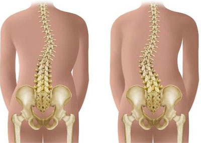 Сколиоз и бодибилдинг